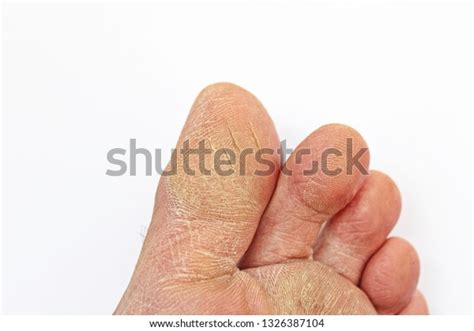 Cracked Skin Toe Isolated Stock Photo Edit Now 1326387104
