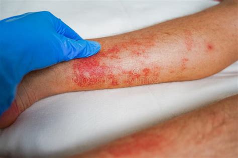 Eczema Skin Disease On The Legs Itchy Red Rashes And Spots Stock Photo