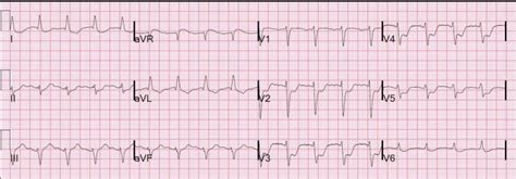 Which Patient Should Get Acute Cath Lab Activation In Mi