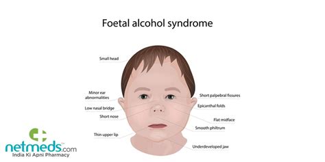 Fetal Alcohol Syndrome Causes Symptoms And Treatment