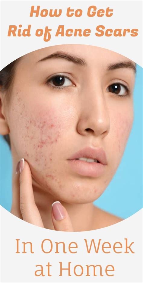 How To Get Rid Of Acne Scars In One Week At Home Remedies For Acne