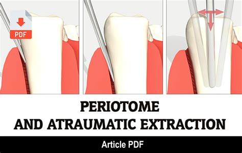 Pdf Knowledge On Periotome And Atraumatic Extraction Among Dental Students