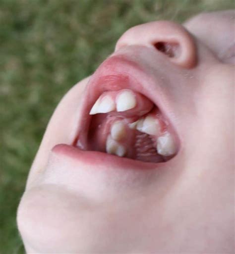 Cleft Lip Cleft Palate Pediatric Dental Care Tips