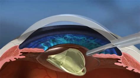 Alcon LenSx Cataract Surgery YouTube