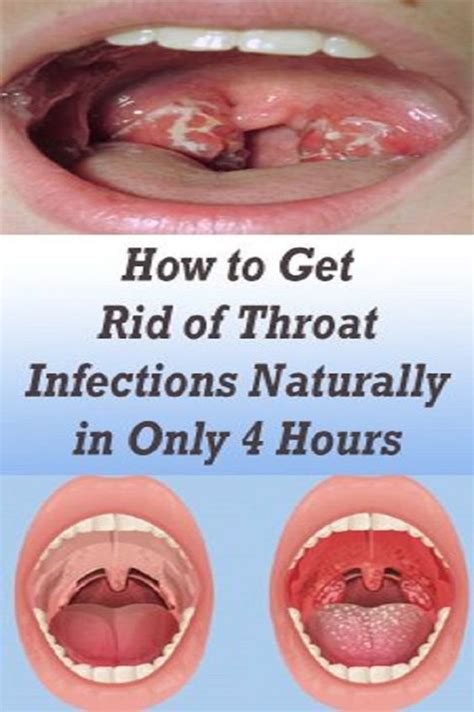 Instructions To Get Rid Of Throat Infections Naturally In Only 4 Hoursthe Specialists Warn That