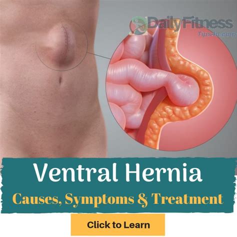 Ventral Hernia Causes Picture Symptoms And Treatment