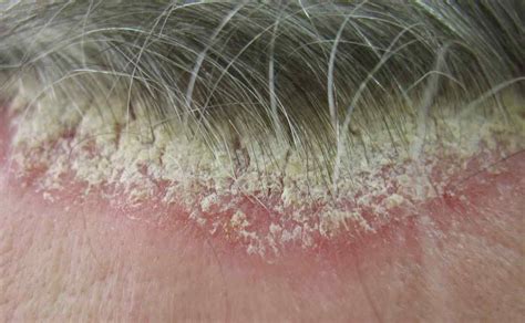 Scalp Psoriasis Scales Pictures Symptoms And Pictures