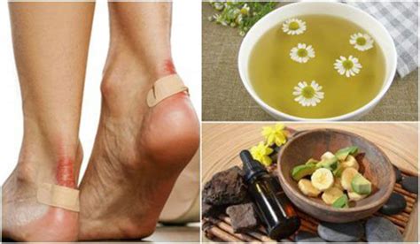 5 Home Remedies To Treat Blisters Naturally Best Herbal Health