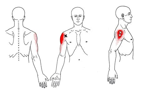 Deltoid The Trigger Point And Referred Pain Guide