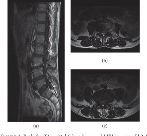 Figure 1 From Lumbar Scoliosis Combined Lumbar Spinal Stenosis And