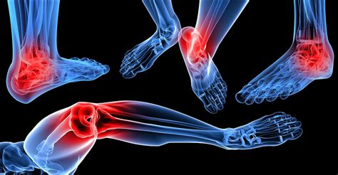 Arch And Heel Pain Treatment Alberta The Foot Institute