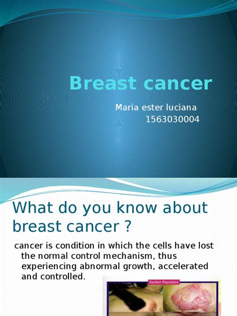 Breast Cancer Ppt