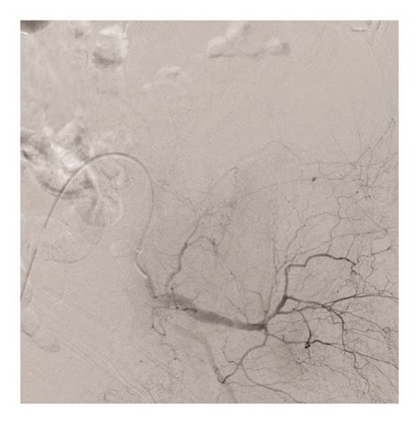 Selective Left Internal Iliac Angiography Confirmed Multiple Spots Of