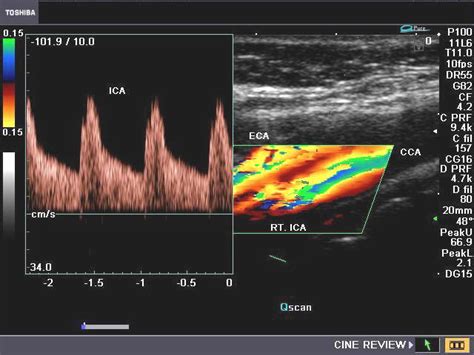 RadiologySpirit Spectral Doppler Waveforms Of The Normal ICA Internal