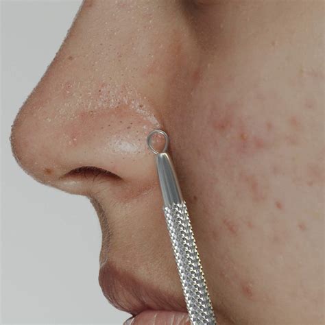 Suvorna Skinpal S35 Lancet For Whitehead Extractor Pimple Milia Pus