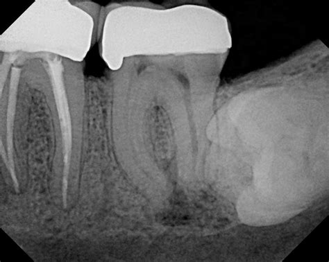 The Endo Blog Persistent Post Treatment Apical Periodontitis