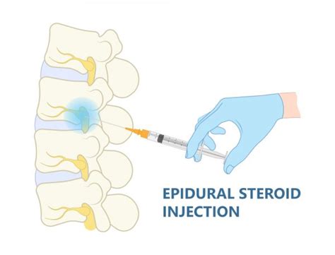 How Does An Epidural Steroid Injection Work For Pain Management