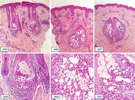 A New Case Of Neutrophilic Sebaceous Adenitis A Photodermatosis