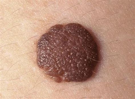 Moles Skin Disorders Merck Manuals Consumer Version