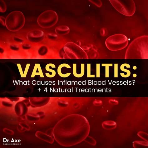 Vasculitis 4 Natural Treatments For Inflamed Blood Vessels Dr Axe