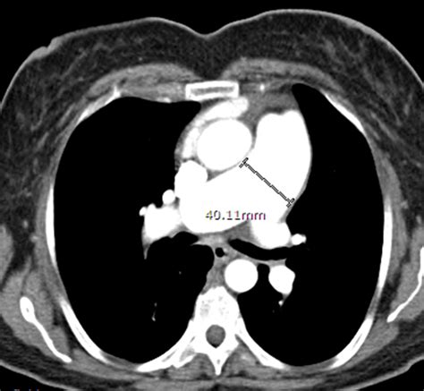 Figure 1 Ct Scan Of The Chest With Iv Contrast The Main Pulmonary