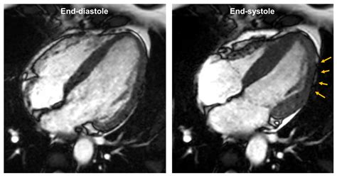 Cureus Acute Myocardial Infarction In A Young Woman Role Of Cardiac