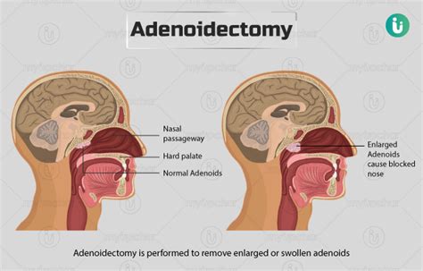 Adenoidectomy Procedure Purpose Results Cost Price