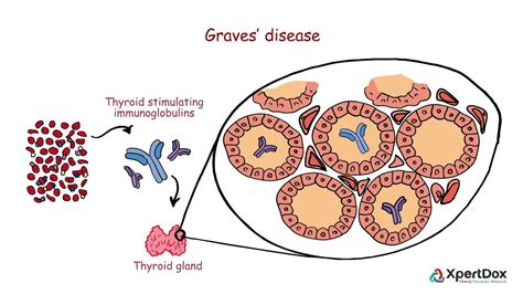 Graves Disease When Your Body Produces Too Much Thyroid Hormone Youtube