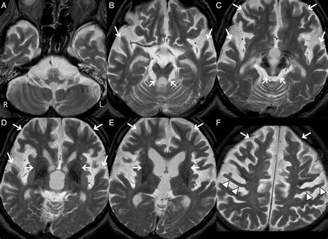 Marked Widespread Atrophy Of The Cerebral Cortex And Brainstem In
