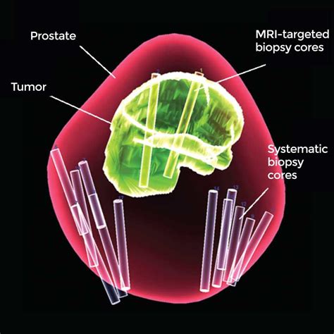 Combined Biopsy Method Improves Prostate Cancer Diagnosis Nci