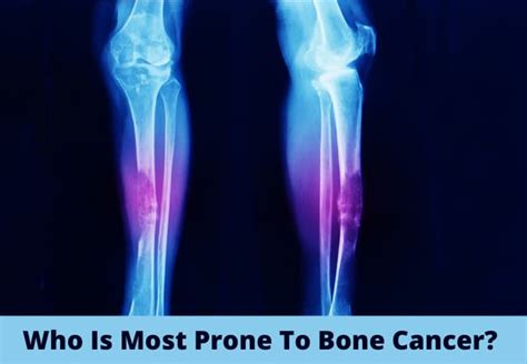 Recognizing The Early Signs Of Bone Cancer What To Look For In The