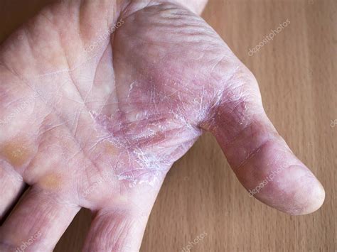 Peeling Dry Skin Hands Concept Treatment Prevention Skin Diseases