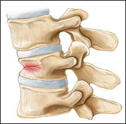 Percutaneous Vertebroplasty | Arizona Pain - Phoenix