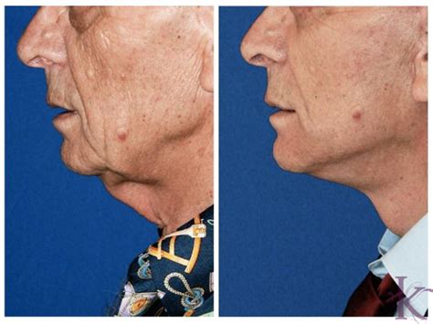 Facelift Dr Vasyukevich Facial Plastic Surgeon Nyc 69