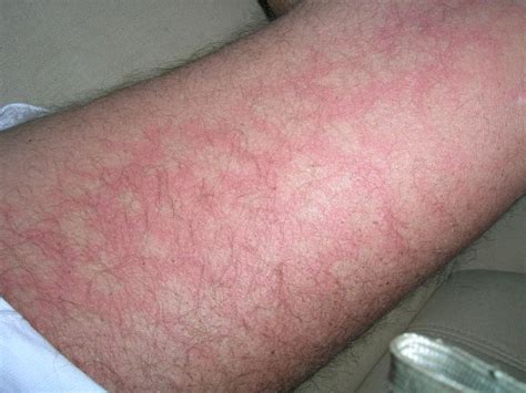 Rote flecken sind meist harmlos. Rote Streifen am Oberschenkel Innenseite (Gesundheit ...