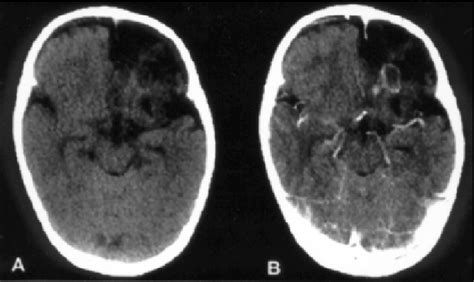 Unhanced Ct Scan A And After Iodine Contrast B Performed 4 Months