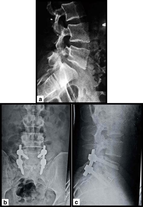 Tlif Procedure For The Patient With Isthmic L5 S1 Spondylolisthesis A