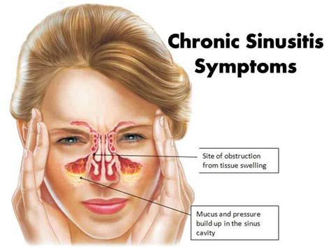 Sinus Pain Causes Symptoms Treatment Headache Healthm