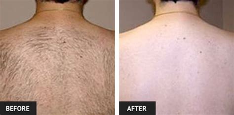 Check spelling or type a new query. Laser Hair Removal Before and After Pictures | Laser Lipo ...