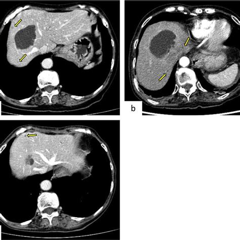 Contrast Enhanced Abdominal Computed Tomography Ct The Arrow