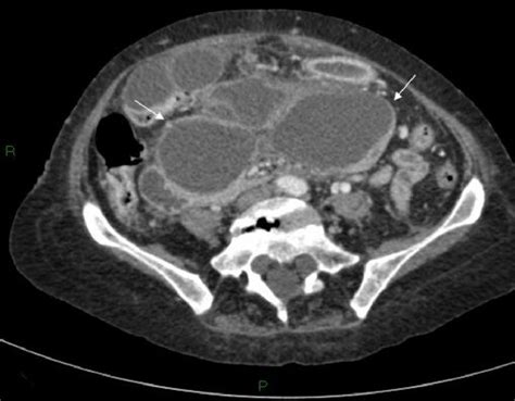 Axial Post Contrast Ct Scan Of The Upper Abdomen Showing The Inferior