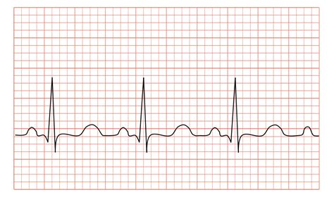 In adults, sinus tachycardia is defined as a heart rate greater than 100 beats/min (bpm). Tachycardia - Wikipedia