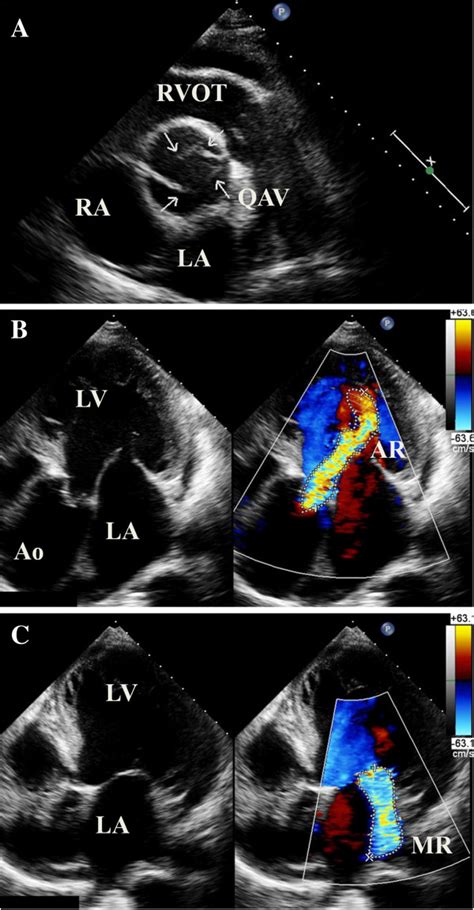 Echocardiography Of A 58 Year Old Man With Quadricuspid Aortic Valve Download Scientific
