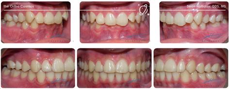 The treatment strategies for correction of overbite range from wearing braces, tooth extraction, invisalign, retainers and jaw surgery. Can We Treat Challenging Malocclusions with Invisalign ...