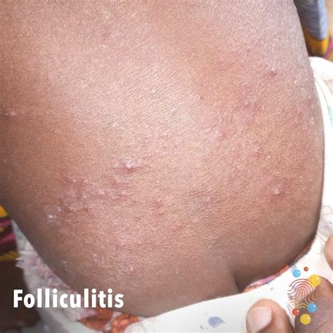 Folliculitis Skin Deep