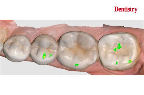 Prosthodontips Restoration Of A Lower Second Molar Dentistry