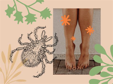 How To Tell If A Tick Head Is Still In Your Skin And How To Remove It