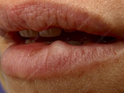 Lip Fibrosis Stock Image C0063600 Science Photo Library