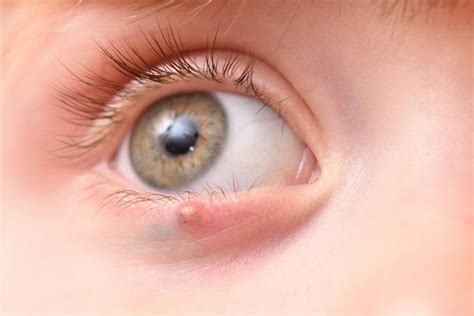 Tips For Recognizing A Stye And What To Do About It Penguin