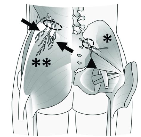 You may also feel a thickening of tissue along the rim of the posterior iliac crest, and there may be tenderness in this region. Superior cluneal nerve (SCN) (arrows) and middle cluneal ...